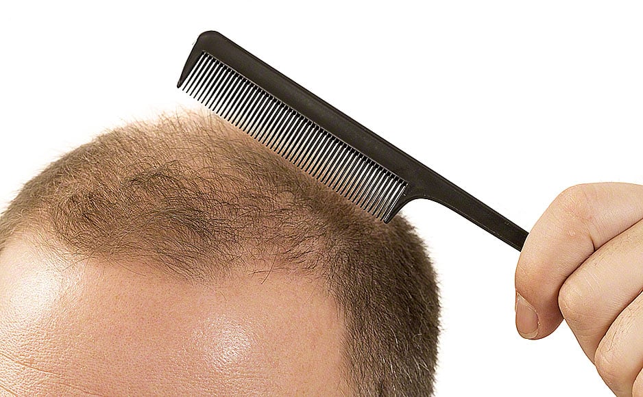 man alopecia baldness hair loss isolated